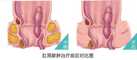 福州肛门红肿会引起什么危害？